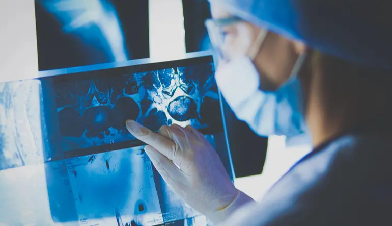 Aggressive breast cancer may hijack nerves to fuel tumor growth
