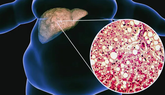 Doctors identify main causes of fatty liver disease leading to transplantation