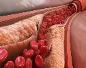 How to prevent heart attack and stroke: 4 ways to lower high cholesterol