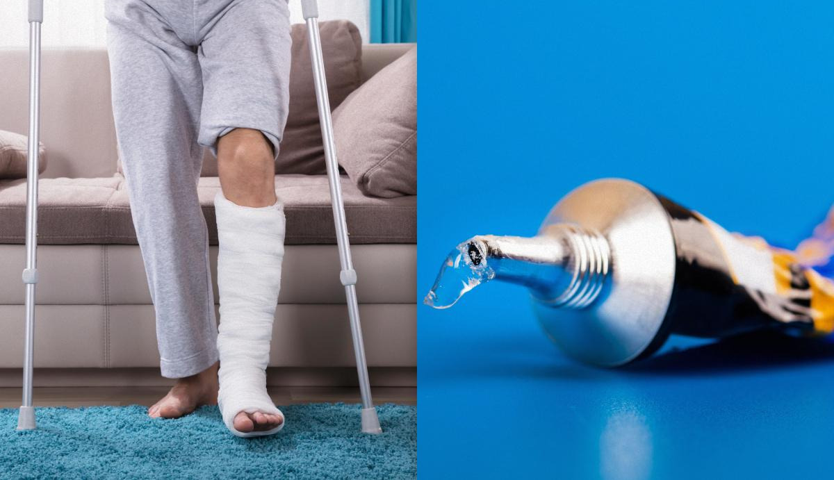 Scientists have developed a “superglue” for bones that heals fractures in just minutes