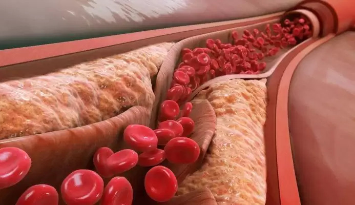 How to prevent heart attack and stroke: 4 ways to lower high cholesterol