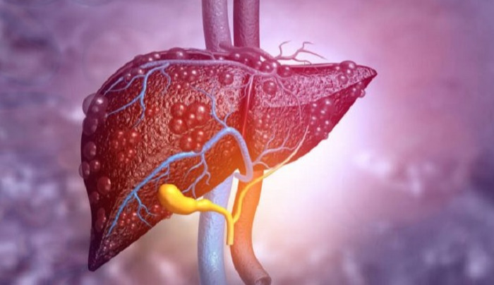 A common habit linked to fatty liver disease has been identified