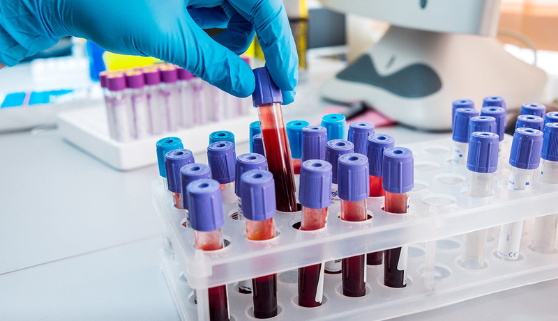 Scientists develop first accurate blood test to detect chronic fatigue syndrome